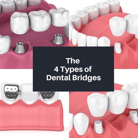 dental bridges rosebud|Dental Bridge: Types, Advantages, Cost, and More.